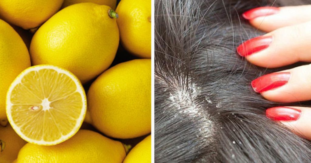 Dandruff? I waved it goodbye thanks to these remedies!