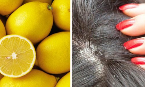 Dandruff? I waved it goodbye thanks to these remedies!